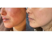 ラトナ(RATNA)/ホワイトハーブ6回