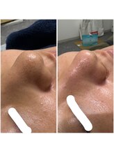 ユニヴェール(univers)/理想の毛穴美人へ