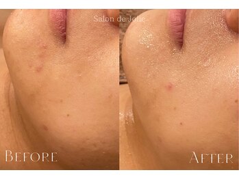 サロンドジョリー(Salon de Jolie)/ハーブピーリング→AEMILIA導入