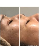 アピロスビアンティ(APEIROS BIANTY)/【ハリつや復活】フェイシャル