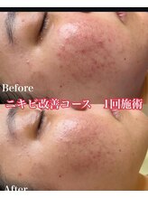 美プラス/《20代》ピーリングのみ