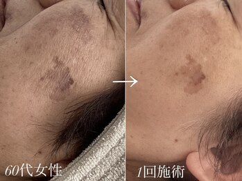 リベルテ(LIBERTE)/60代のシミケア