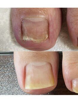 シーネイル(C Nail)/伸びなくなってしまったお悩み爪