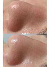 リベルテ(Liberte)/セレクト毛穴管理