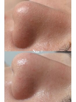 リベルテ(Liberte)/セレクト毛穴管理