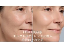 憩いサロンユリ 蕨店(Yuri)/エレクトロポーレション導入