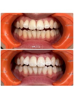 エクシアホワイトニング 日本橋店/初回!