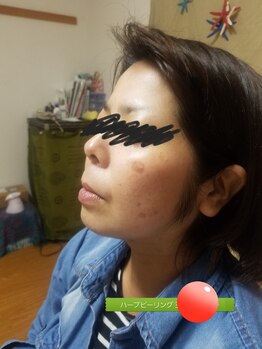 プラーベートサロン エクラ(eclat)/ハーブピーリング後日