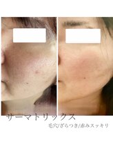 プレジール(Plaisir)/サーマトリックス