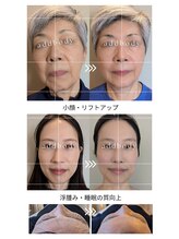 アドボディ(ADD BODY)/Before→After