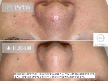 ラヴィオーラ 姫路店(La Viora)/ダイヤモンドハーブピーリング