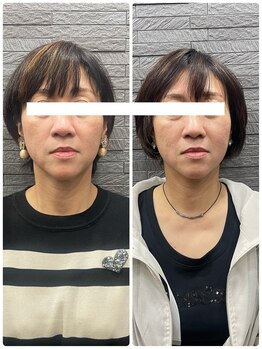 長寿鍼灸院 長寿整骨院/美容鍼50本の効果★ハリ・ツヤ