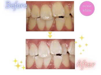 エクシアホワイトニング エミフルMASAKI店/ホワイトニングビフォーアフター