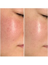 サロン ウーカ(salon WOOCA)/REVI陶肌トリートメント