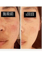 ジーニー(Genie)/リベル　ハーブピーリング