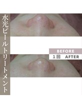 アップルミント/＜フェイシャル＞before・after