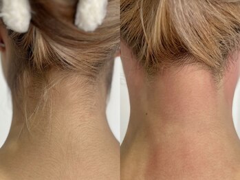 シロ(Shiro)/MIX脱毛うなじデザイン