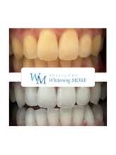 ホワイトニング モア(Whitening MORE)/ビフォーアフター