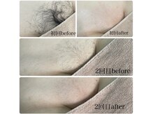 エステ リラクゼーションサロン(more)/VIOミックス脱毛