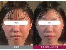 すぐ楽 四条烏丸の雰囲気（数少ないスライドカッピング導入店。小顔/痩身効果も絶大◎）