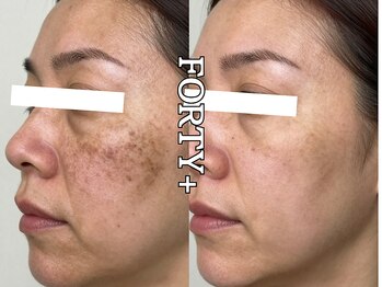 フォーティープラス(FORTY+)/施術事例