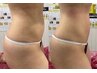 【初夏キャンペーン】浮腫、セルライトを撃退！痩身エステ12,000円→5,000円