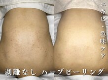 ダリア(Dahlia)/赤ニキビ、色味ケアに