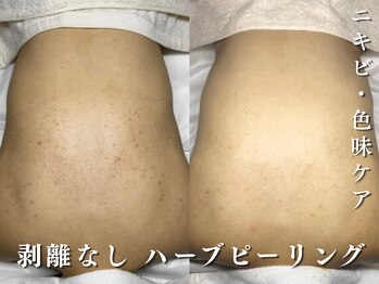 ダリア(Dahlia)/赤ニキビ、色味ケアに