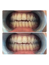 エスデザイン(es design)/セルフホワイトニング／鹿児島