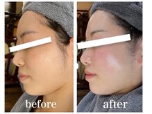 ルー ハナレ 神戸岡本 摂津本山店(Luu HANARE)/小顔リフトアップ/シミ毛穴改善