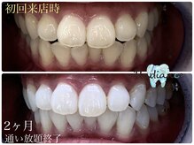 札幌セルフホワイトニング ラディアンス(Radiance)/ホワイトニング2ヶ月通い放題