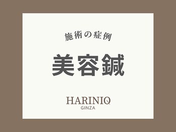 ハリニーク 銀座店(HARINIQ)/美容鍼による施術一覧