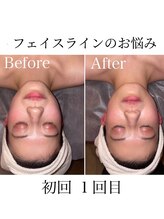 サロン スムース(Salon SMOOOTH)/光フェイシャル1回目比較