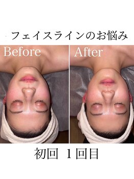 サロン スムース(Salon SMOOOTH)/光フェイシャル1回目比較