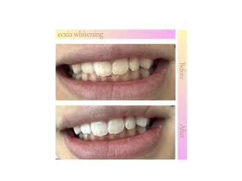 エクシアホワイトニング エミフルMASAKI店/ホワイトニングビフォーアフター