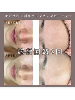 ベルミー(Bellmi)/毛穴洗浄＋シフォンピーリング