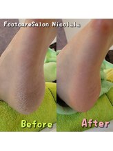 ニコルル 春日部店(Nicolulu)/集中かかと&角質ケア