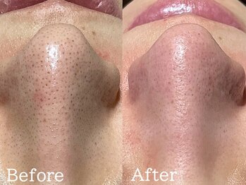 ルナステラ 金沢店/ハイドロ毛穴洗浄