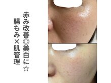 ソルレ 宮崎店(SOLURe)/赤み改善美白に◎腸もみ×肌管理