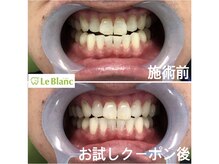 ルブラン 奈良店(Le Blanc)/白い歯は維持してこそ魅力的