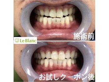 ルブラン 奈良店(Le Blanc)/白い歯は維持してこそ魅力的