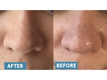 ステラ(Stella)/いちご鼻、卒業しましょ♪