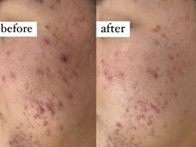 アワピール 成田公津の杜店(AWA PEELL)/ハーブピーリングで肌荒れ改善