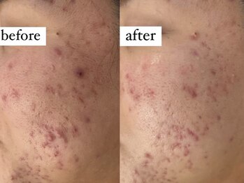 アワピール 成田公津の杜店(AWA PEELL)/ハーブピーリングで肌荒れ改善