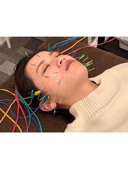 鍼灸整骨院ひで/施術風景~美容鍼~