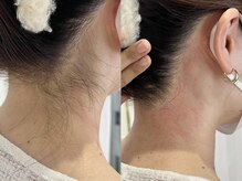 シロ(Shiro)/MIX脱毛うなじデザイン