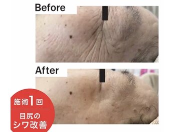 エン(O'en)/エクソソーム+幹細胞培養液導入