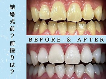 ホワイトニングショップ 八王子店/八王子ホワイトニングブライダル