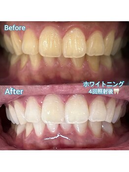 サロン ベレッツァ(Salon Bellezza)/ホワイトニング施術例