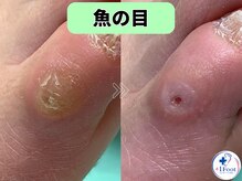 プラスワンフット 本厚木(+1 Foot)/タコ・魚の目ケア！痛みから解放